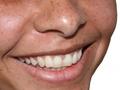 Białe zęby - jak wybielać, czego unikać