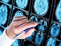 Postęp w badaniach nad leczeniem choroby Alzheimera