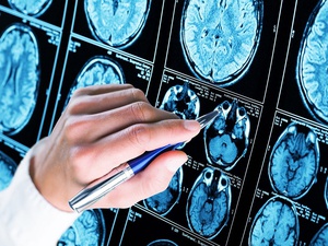 Postęp w badaniach nad leczeniem choroby Alzheimera